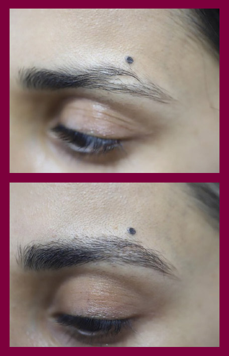 eyebrow-reconstruction-service