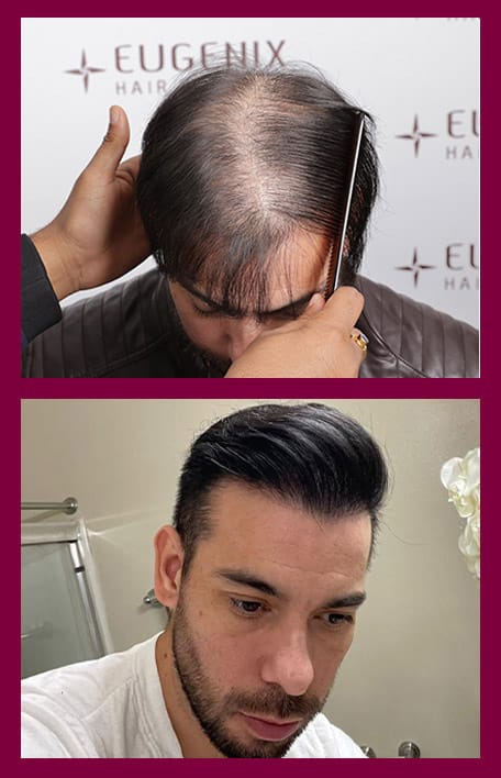 hairline-reconstruction-service2-inter