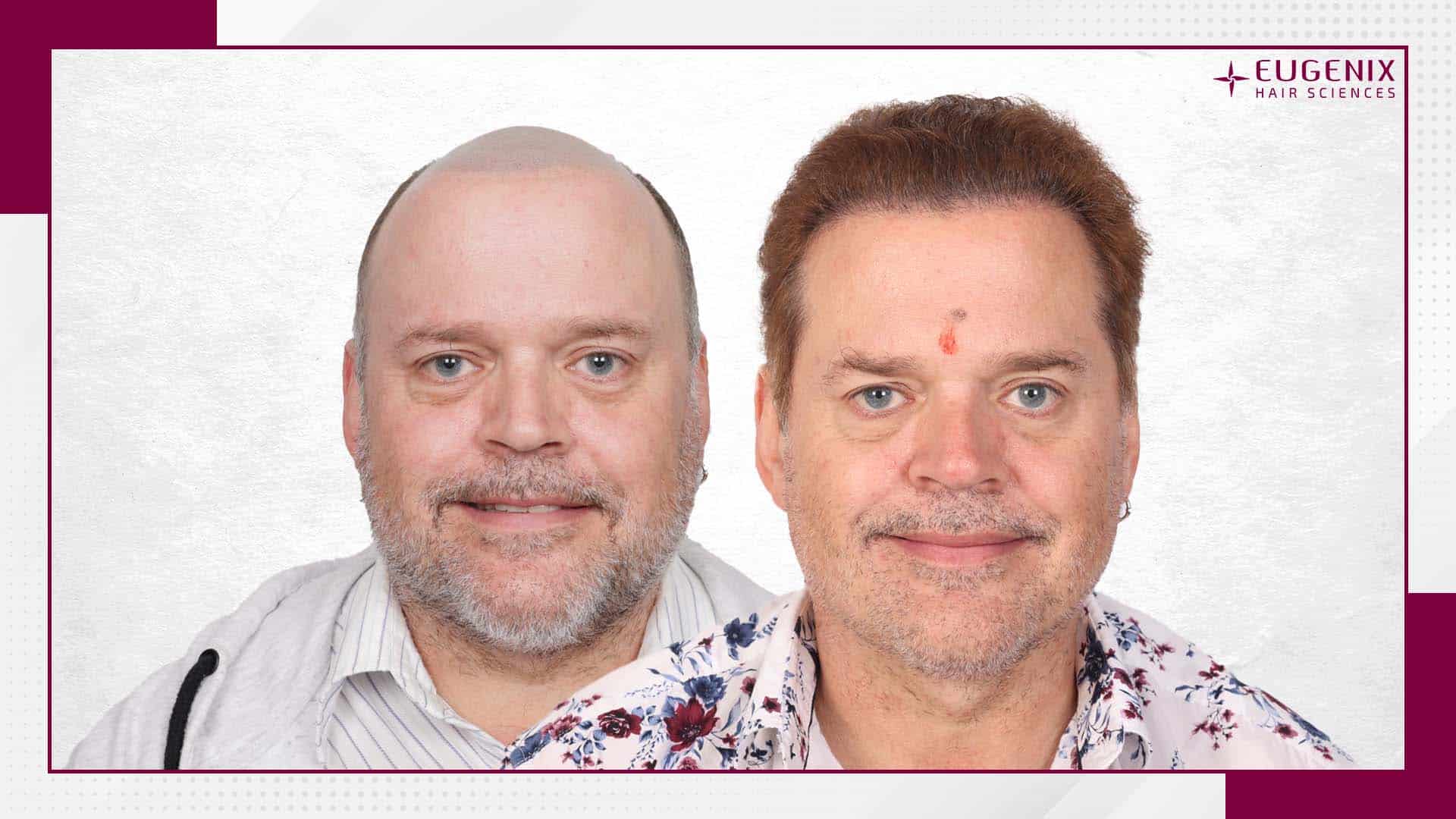 Adrian Brown Body Hair Transplant