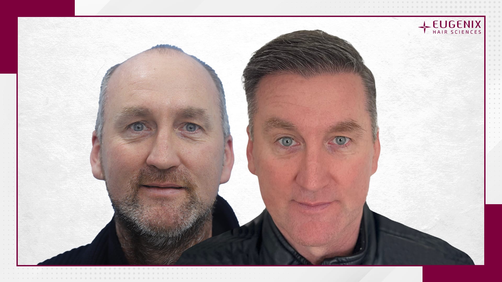 male-hair-transplant-before-and-after-uk-3