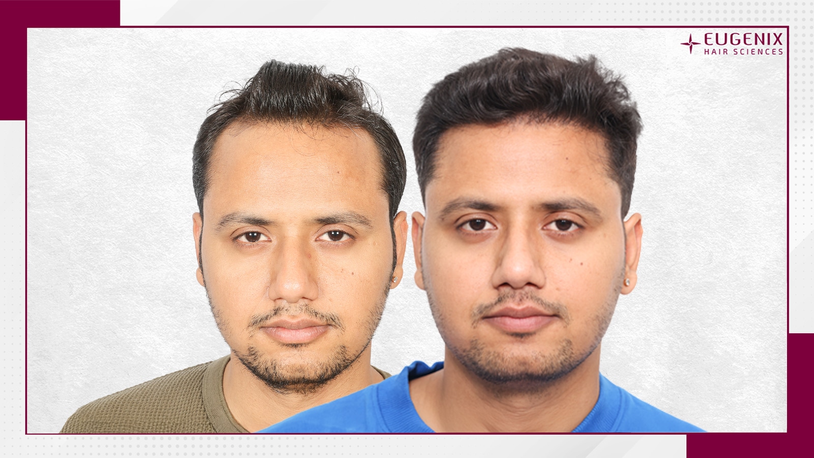 Standard-Before-After (2)