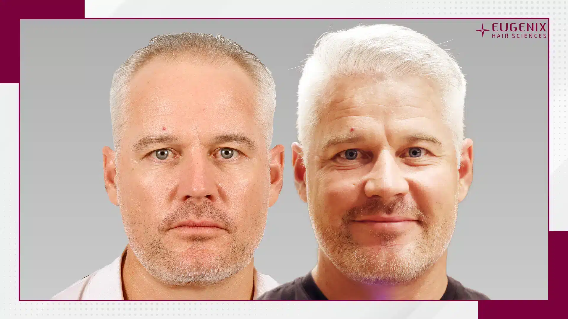 Morne-Van-Wyk-Hair-Transplant.jpg
