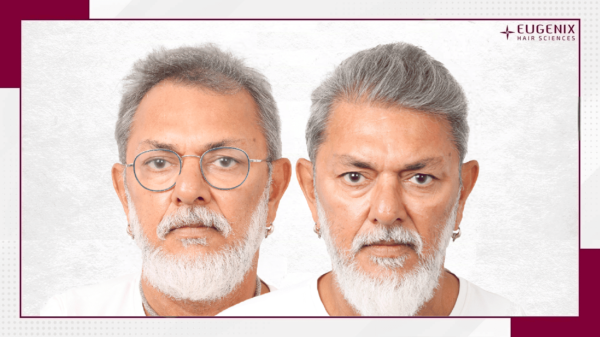 Rakeysh-Omprakash-Mehra-Hair-Transplant-1 (1)