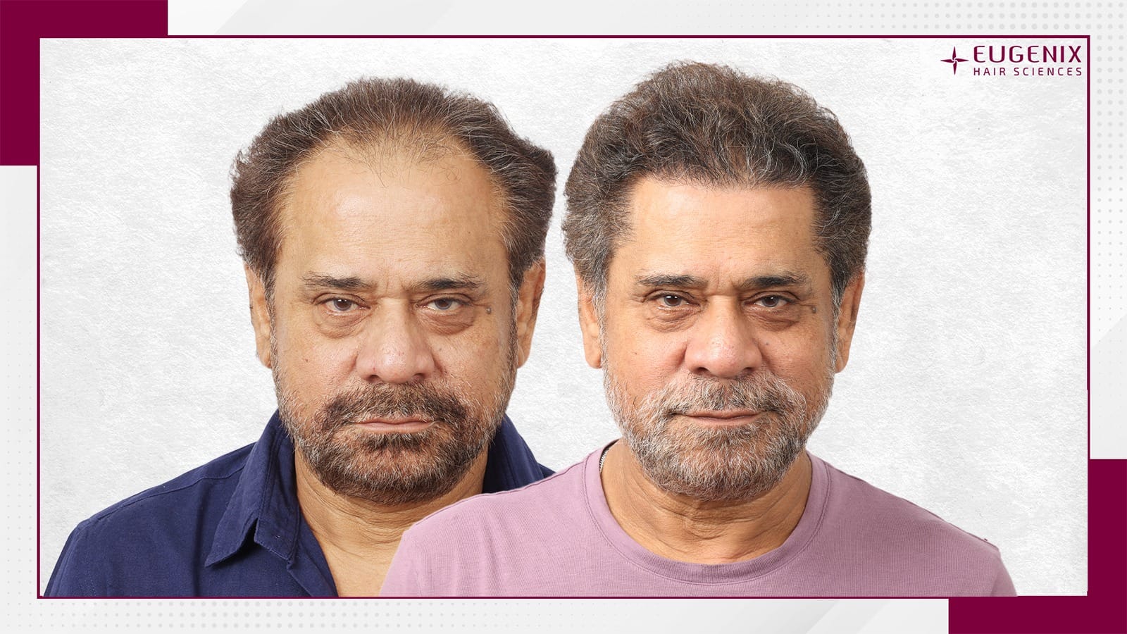 anees-bazmee-hair-transplant