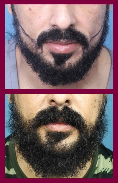 beard-hair-transplant-service