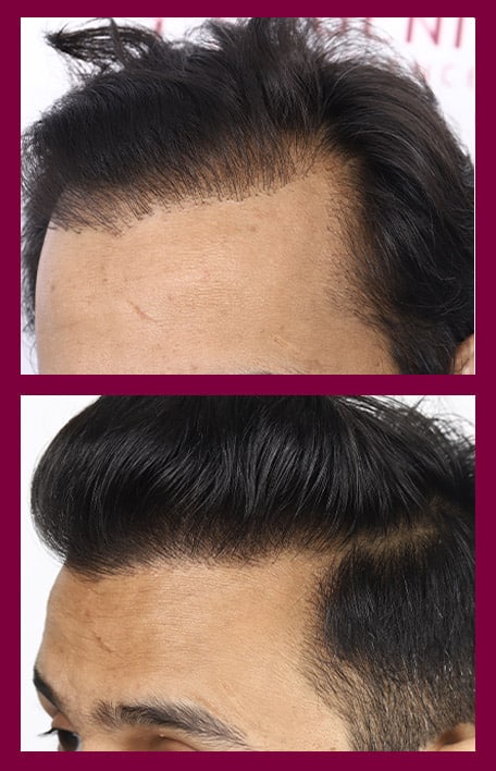 corrective-hair-transplant-service-inter
