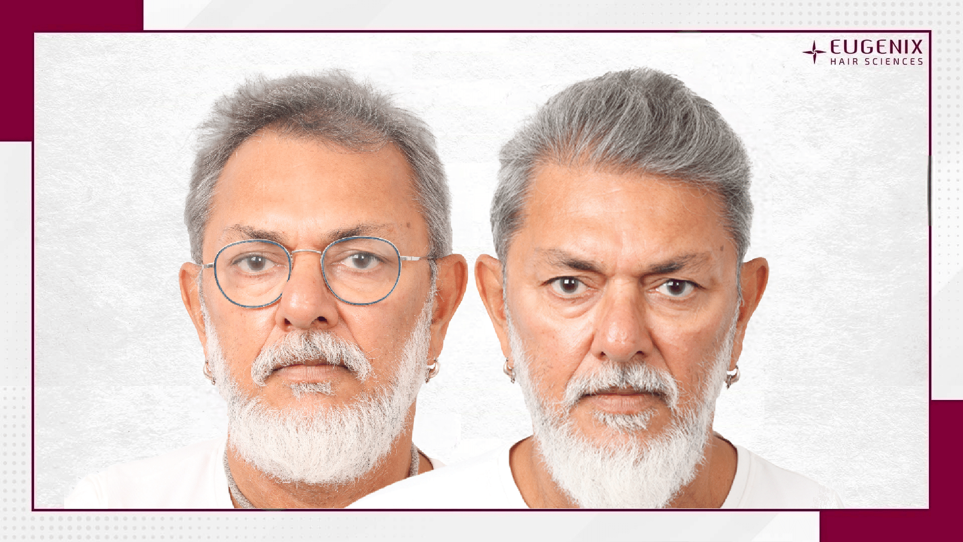 Rakeysh Omprakash Mehra - Hair Transplant-1