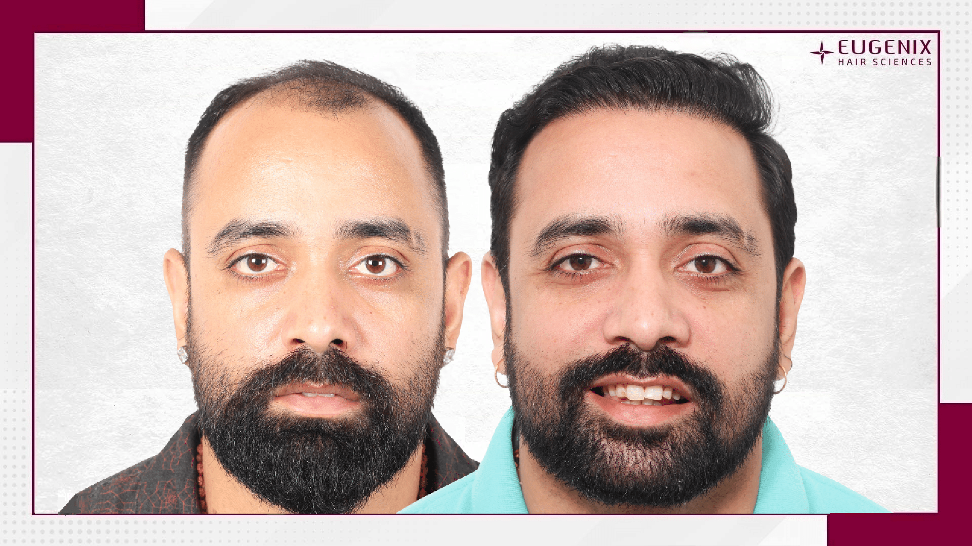Vishesh Bhriguvanshi - Hair Transplant-1
