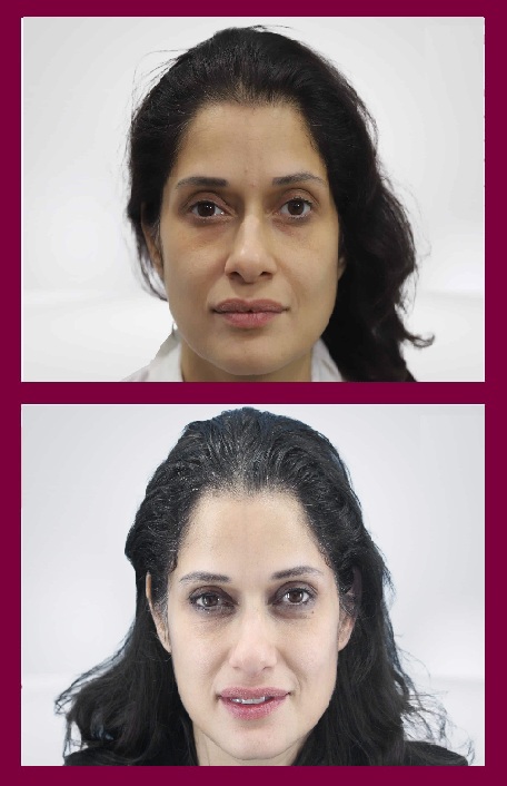 hair-transplant-in-females-service