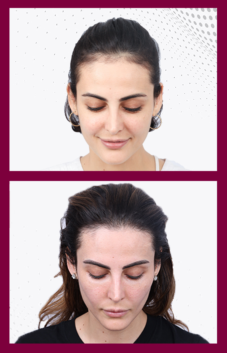 hair-transplant-in-females-service