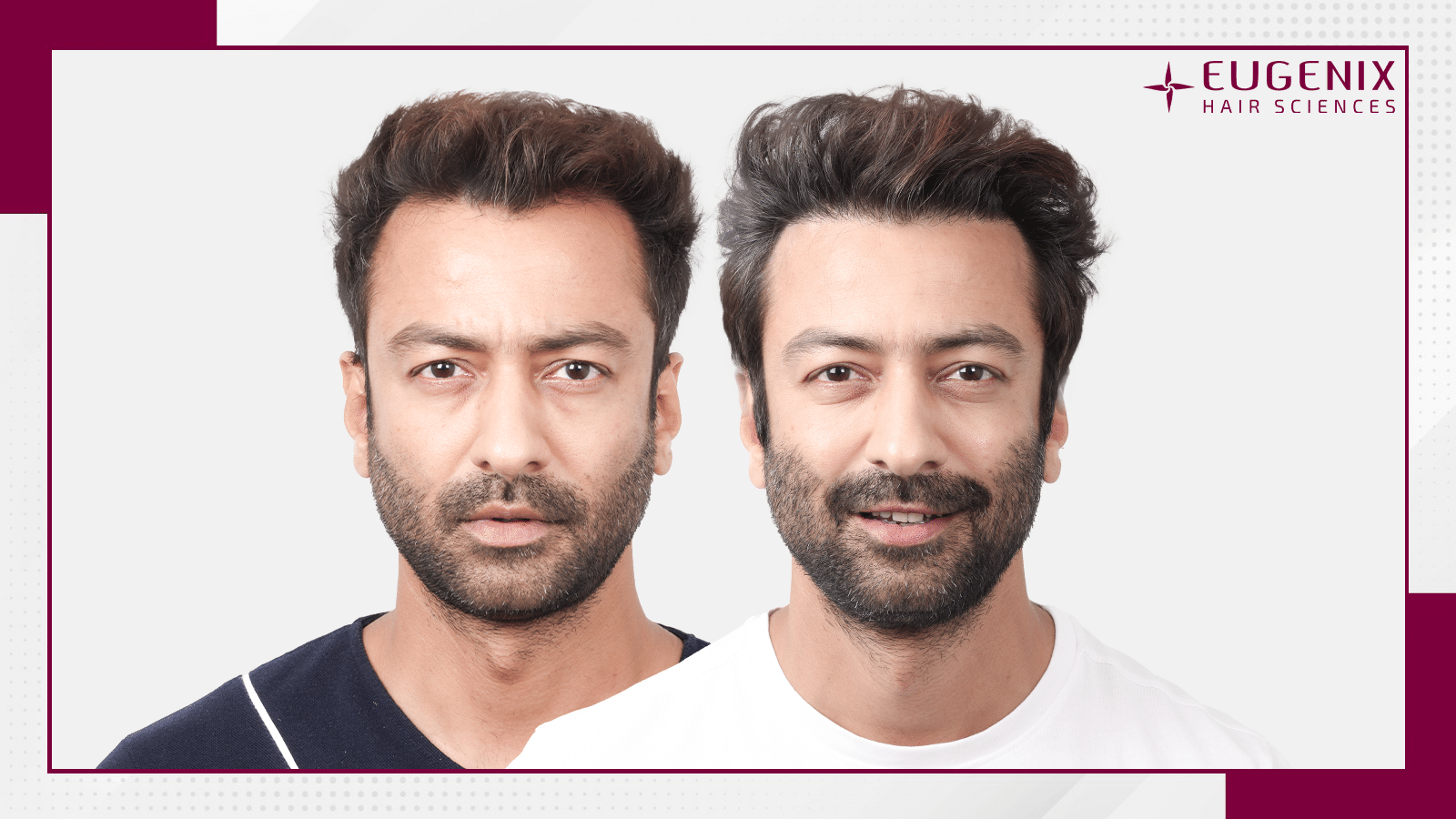 Jatin-Shah-hair-transplant